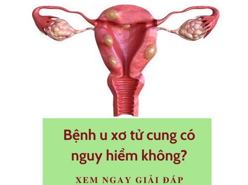 Bệnh u xơ tử cung có nguy hiểm không? - Xem ngay giải đáp!